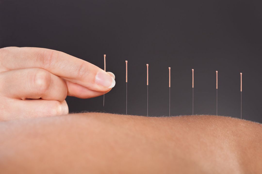 China Gunakan Akupuntur Atasi Pasien COVID-19-Image-1