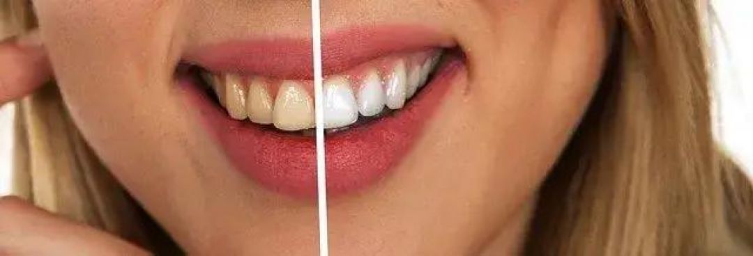 Rajin Menyikat Gigi Tapi Gigi Tetap Tidak Putih?-Image-1