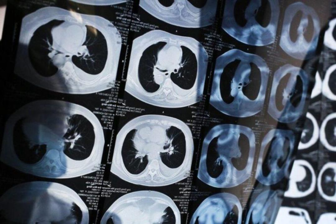 Ilmuwan China Kembangkan Alat Bantu Deteksi Kanker Paru-paru-Image-1
