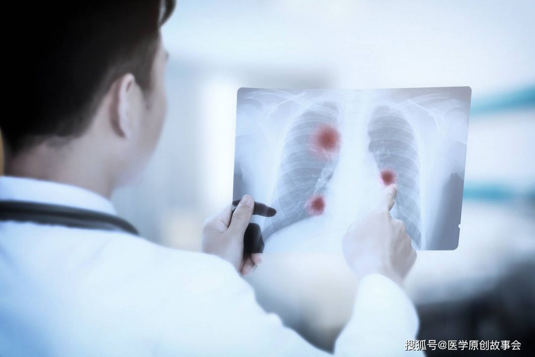 4 Tips Dalam Mencegah Kanker Paru-paru-Image-2